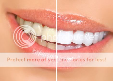 clareamento dental caseiro fotos antes e depois